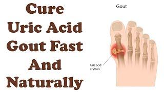 Reverse High Uric Acid and Remove Kidney Stone Naturally- Dr. Kunal Malik