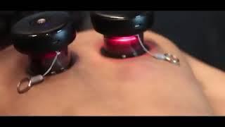 achedaway smart cupping physioway