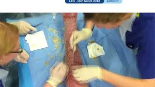 Debridement of a leg ulcer - Leg ulcer treatments at the 2nd International Veins Meeting