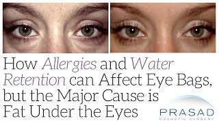 How Allergies and Water Retention can Affect Eye Bags, but the Major Cause is Fat Under the Eyes