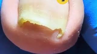 Cut Dirty Ingrown Toenail 剪大脏向内生长脚趾甲 #shorts #video #health