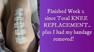 Finished WEEK 2 of my TOTAL KNEE REPLACEMENT...plus removed my bandage!!! #kneesurgeryrecovery