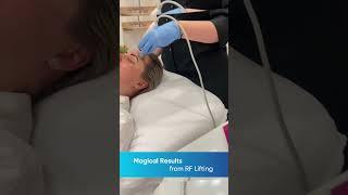 Wow! Result after RF lifting #lifting #skincare #beauty #aesthetic #face