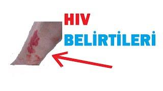 HIV BELİRTİLERİ NE ZAMAN BAŞLAR ?