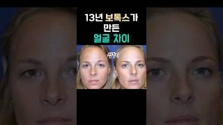 13년 보톡스 실험, 쌍둥이얼굴 이렇게 바뀜