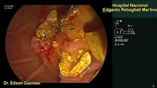 ELECTROHYDRAULIC LITHOTRIPSY (EHL): A DEMONSTRATIVE EXAMPLE