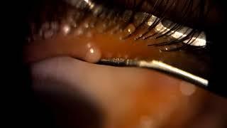 Eyelid squeezing - popping a stye