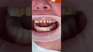 Dental crowns on front teeth | dental crown procedure front tooth | porcelain veneers | Dr. Yazdan