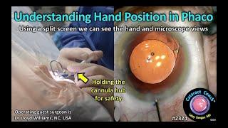 CataractCoach™ 2324: understanding hand position in phaco