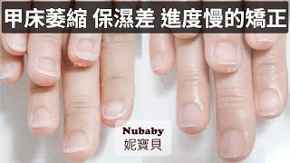 Nail Biting Correction Case｜Stress of Accounting Freshers｜Nail Bed Shrinkage Poor Moisturization