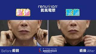 Renuvion氦氣電漿｜下顎緊實｜術前術後對比｜周爾康整形外科診所