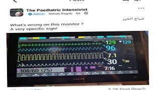 what's wrong in this monitor? Dr Rehab Ragab Elseidy. #Capnogram #capnography