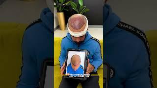 Patient after his hair transplant in Miami  | Care4Hair