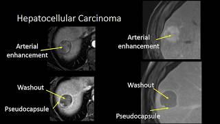 GI Imaging - Cirrhosis