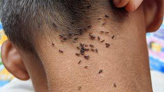 Get out all lice from his black hair - Remove all hundred lice from head