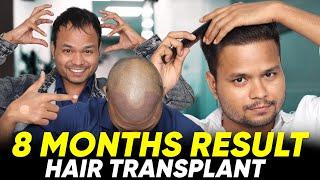 Hair Transplant in Delhi | Best Results & Cost of Hair Transplant in Delhi