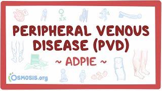 Peripheral venous disease (PVD): Nursing Process (ADPIE)