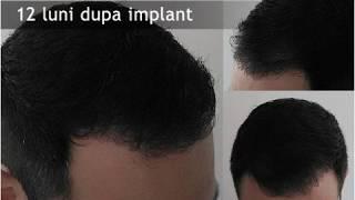 Best Fue Hair Transplant Before and After pictures Results - Dr. Felix Hair Implant Romania, Europe