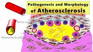 Atherosclerosis | Pathogenesis and Morphology | Learn by animation