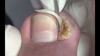 Bad case of ingrown nail