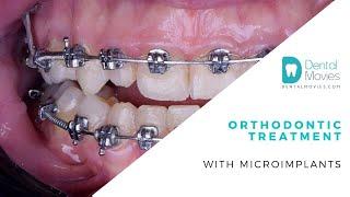 Orthodontic treatment with microimplants