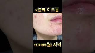 250106, 여드름피부변화, 미백세럼, 여드름흉터, 여드름자국, 여드름피부를 매일 기록하며 공유합니다.