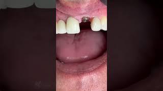 For one implant!
