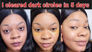 I removed dark circle under the eyes in 5 days/ How to remove dark under eye #acne #beauty #diy