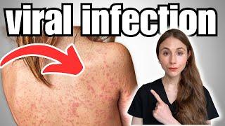 Signs Of Viral Infection Not To Miss | Skin Rashes