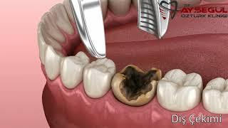 Tooth Extraction