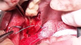 16 may 2014. Ilya Makaryevskiy + Implay Implants. Immed. Imp. Part 2