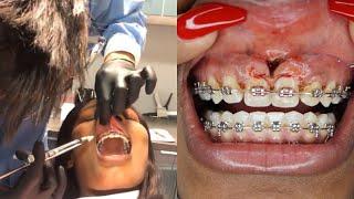 8 Month Braces Update.. I Got A Frenectomy! | Starring Shameka