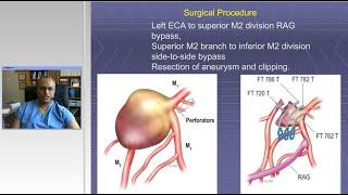 Management of Complex Aneurysms: Clip Reconstructions and Bypass Techniques (Preview)