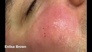 Christian's Acne Treatment ( Blackheads Extractions)