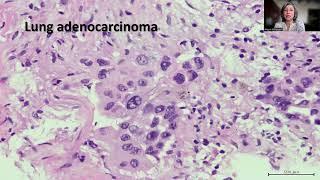 Tip-60; Lung Adenocarcinoma Presenting with Epistaxis