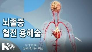 뇌졸중 혈전 용해술 - 723회(20.01.22) 잘 모르면 더 치명적인 뇌졸중