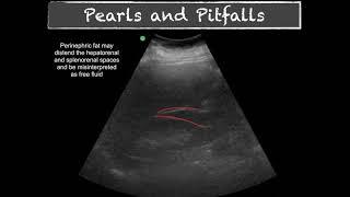 POCUS -  E FAST - Pitfalls