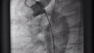 Coarctation of the aorta (CoA) angiogram | Dr D. Malleswara Rao