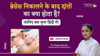 What Happens After Your Braces Are Removed? Know Everything Step By Step | Agra UP - Dr Pooja Sharma