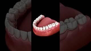 Partial Denture | Dentist in indore | Dental clinic in indore