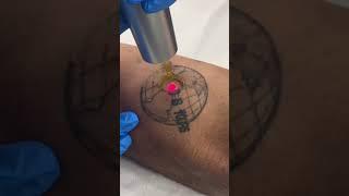 Would you get rid of this tattoo? #tattooremoval #lasertattooremoval #tattooremover #laser #tattoo