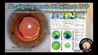 CataractCoach 1251: re-aligning a toric IOL without OVD