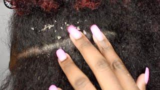 FLAKY DRY SCALP | SCRATCHING DANDRUFF Ep31 #dandruff #scalpraking