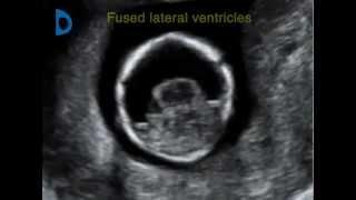 Fetal Medicine Foundation - alobar holoprosencephaly 12 weeks