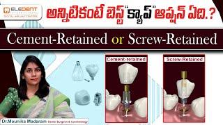 Which Type of Capping is Best for Teeth? || Screw-Retained Crown Vs Cemented Crowns || Eledent