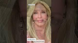 2 Years Post Facelift Surgery! Are the Results STILL THERE?