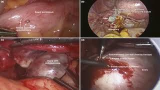 P5  Dr Mudzamiri   MEDICAL MANAGEMENT OPTIONS FOR ENDOMETRIOSIS