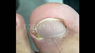 The Big Ingrown Toenail Treatment Tutorial #tonailroomb