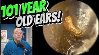 101 YEAR OLD EARS! 385 #ear #earwax #earwaxremoval #satisfying #foryou #fyp #foryourpage