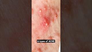 6 Types of Acne Explained #shorts #acne